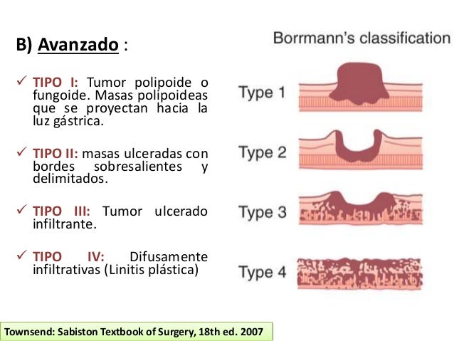 clasificacion de lauren para cancer gastrico pdf